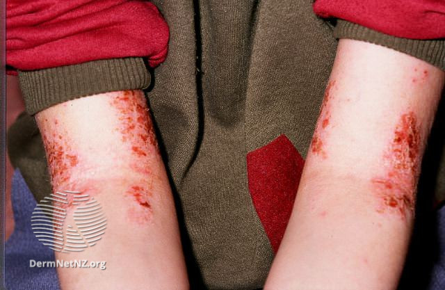 File:Atopic dermatitis (DermNet NZ dermatitis-flexural-eczema02).jpg