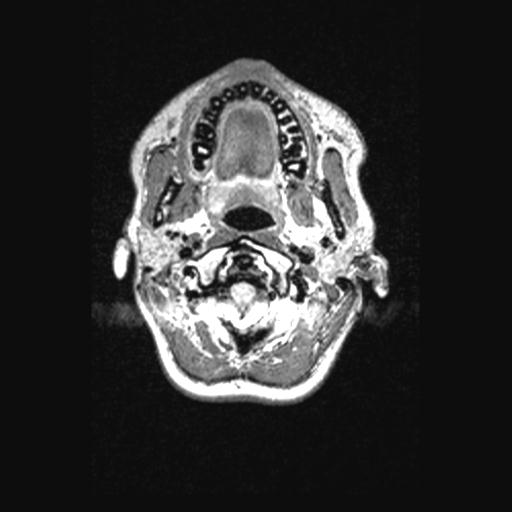 Atretic encephalocoele with inferior vermis hypoplasia (Radiopaedia 30443-31108 Axial 14).jpg
