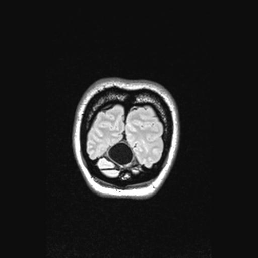 Atretic encephalocoele with inferior vermis hypoplasia (Radiopaedia 30443-31108 Coronal FLAIR 23).jpg