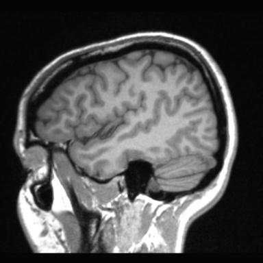 Atretic encephalocoele with inferior vermis hypoplasia (Radiopaedia 30443-31108 Sagittal T1 107).jpg