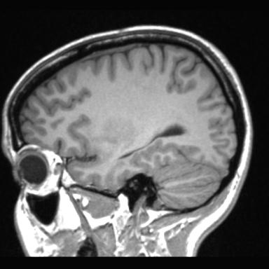 Atretic encephalocoele with inferior vermis hypoplasia (Radiopaedia 30443-31108 Sagittal T1 36).jpg
