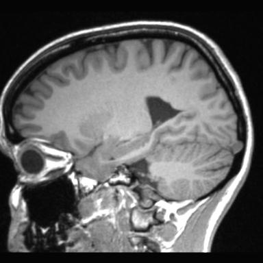 Atretic encephalocoele with inferior vermis hypoplasia (Radiopaedia 30443-31108 Sagittal T1 87).jpg