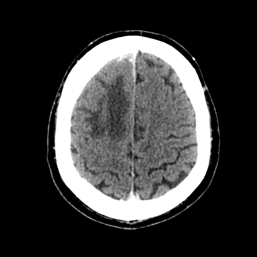 File:Atypical meningioma (WHO grade II) with brain invasion (Radiopaedia 57767-64728 Axial C+ 13).png