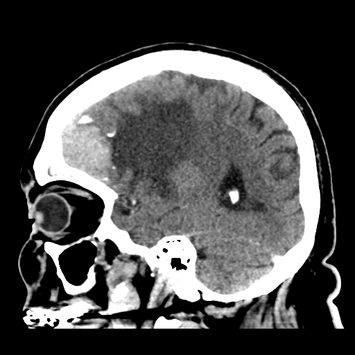 Atypical meningioma (WHO grade II) with brain invasion (Radiopaedia 57767-64728 Sagittal C+ 16).png