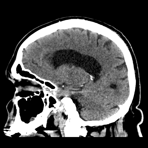 Atypical meningioma (WHO grade II) with brain invasion (Radiopaedia 57767-64728 Sagittal C+ 32).png
