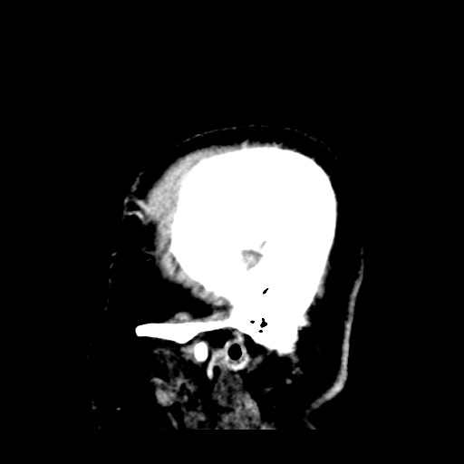Atypical meningioma (WHO grade II) with brain invasion (Radiopaedia 57767-64728 Sagittal C+ 49).png