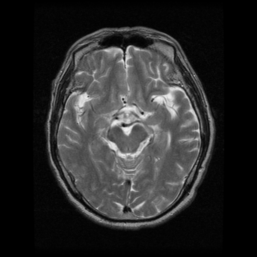 File:Atypical meningioma (WHO grade II) with osseous invasion (Radiopaedia 53654-59716 Axial T2 9).png