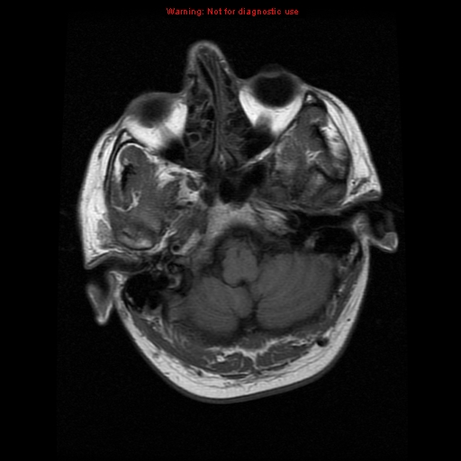 File:Atypical meningioma - grade II (Radiopaedia 13303-13305 Axial T1 4).jpg
