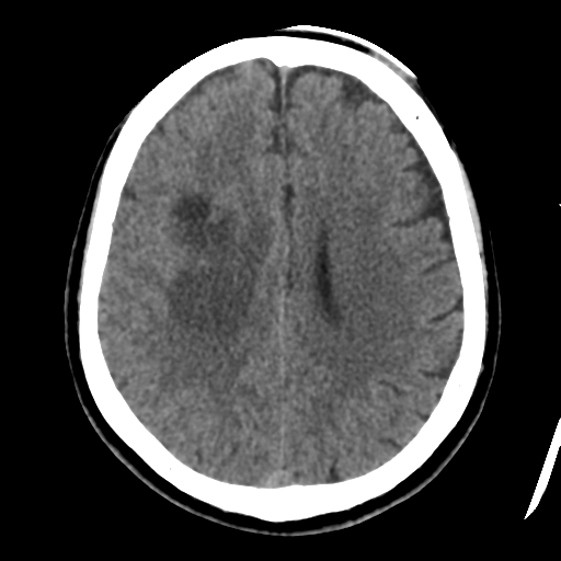 Atypical meningioma with skull invasion (Radiopaedia 34357-35649 Axial non-contrast 35).png