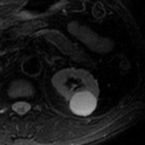 File:Atypical renal cyst on MRI (Radiopaedia 17349-17046 Axial T2 fat sat 7).jpg