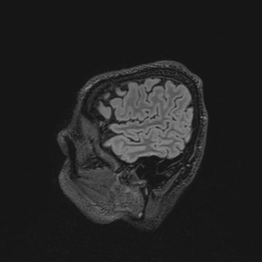 Autoimmune limbic encephalitis (Radiopaedia 30363-31005 Sagittal FLAIR 28).jpg