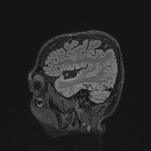 Autoimmune limbic encephalitis (Radiopaedia 30363-31005 Sagittal FLAIR 39).jpg