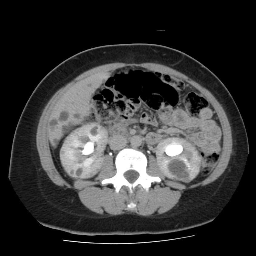 Autosomal dominant polycystic kidney disease (Radiopaedia 23061-23093 C+ delayed 35).jpg