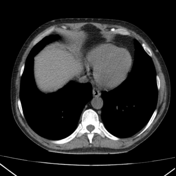 File:Autosomal dominant polycystic kidney disease (Radiopaedia 36539-38101 Axial non-contrast 6).jpg