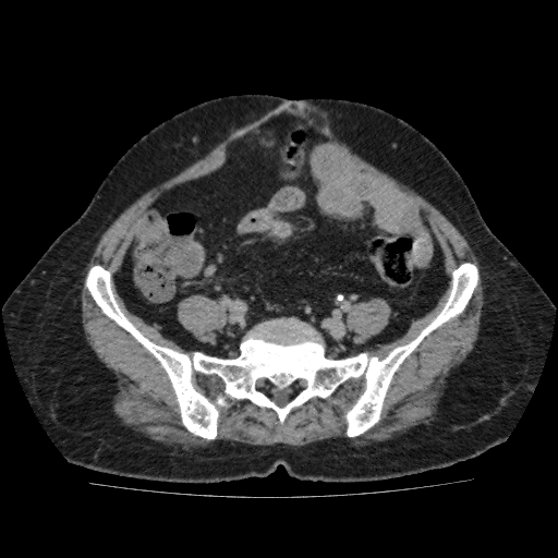 File:Autosomal dominant polycystic kidney disease (Radiopaedia 38189-40194 Axial C+ delayed 41).jpg