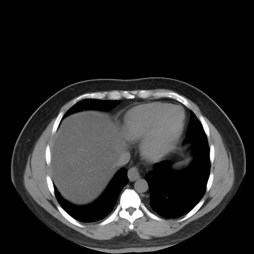 Autosomal dominant polycystic kidney disease (Radiopaedia 50259-55612 Axial non-contrast 13).jpg