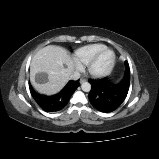 Autosomal dominant polycystic kidney disease with hepatic involvement (Radiopaedia 32693-33662 B 7).jpg