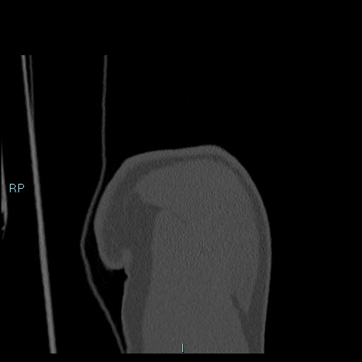 Avascular necrosis after fracture dislocations of the proximal humerus (Radiopaedia 88078-104655 Coronal bone window 27).jpg
