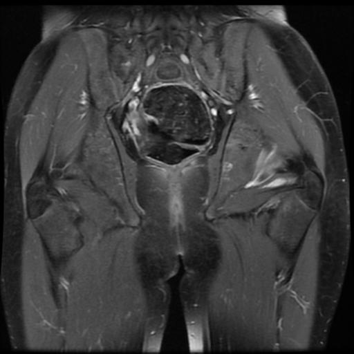 File:Avascular necrosis of the hip (Radiopaedia 29563-30067 I 12).jpg
