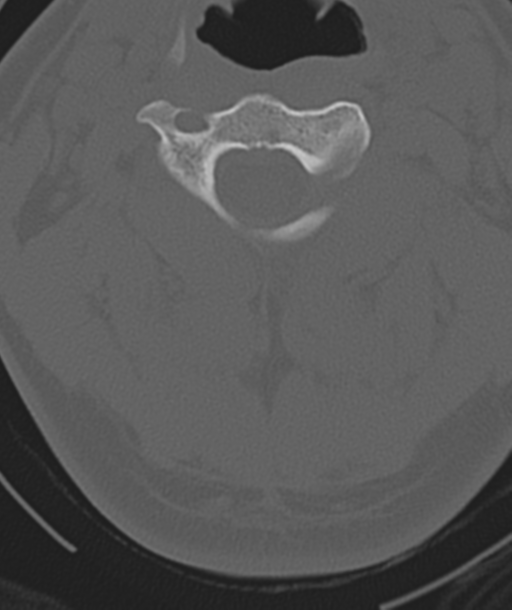 Axis peg fracture (type 3) and atlas lateral mass (type 4) fracture (Radiopaedia 37474-39324 Axial bone window 19).png