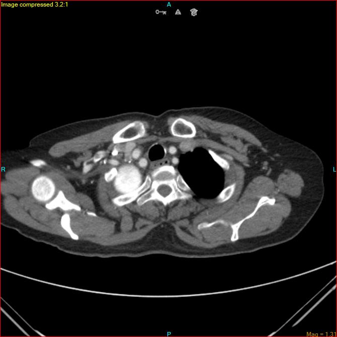 Azygos vein aneurysm (Radiopaedia 77824-90130 B 10).jpg