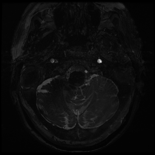 Balo concentric sclerosis (Radiopaedia 53875-59982 Axial T2 FIESTA 1).jpg