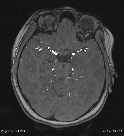 Balo concentric sclerosis (Radiopaedia 61637-69636 Axial MRA 126).jpg