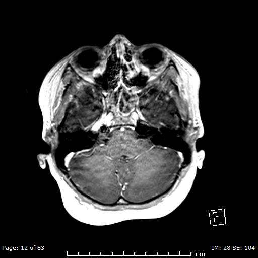 Balo concentric sclerosis (Radiopaedia 61637-69636 Axial T1 C+ 12).jpg