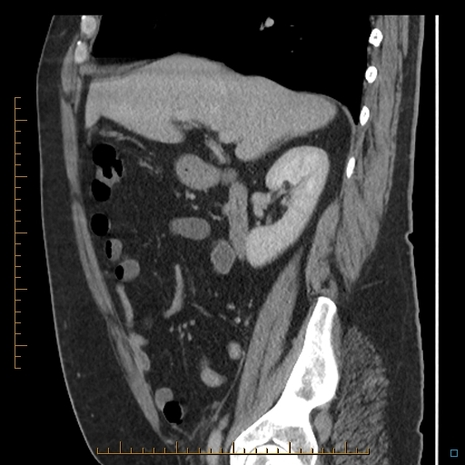 Bariatric balloon causing gastric outlet obstruction (Radiopaedia 54449-60672 C 54).jpg