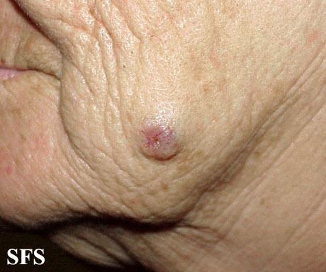 Basal Cell Carcinoma (Dermatology Atlas 148).jpg