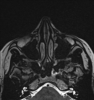 Basal cell carcinoma - nasal region (Radiopaedia 70292-80365 Axial Gradient Echo 36).jpg