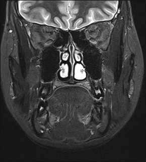 File:Basal cell carcinoma - nasal region (Radiopaedia 70292-80365 Coronal STIR 16).jpg