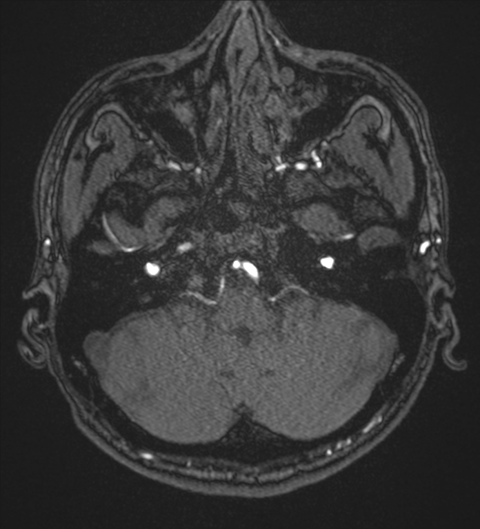 Basal ganglia subacute infarct (Radiopaedia 80201-93521 Axial MRA 5).png