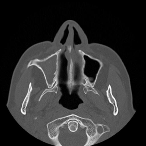 File:Base of skull chondrosarcoma (Radiopaedia 30410-31071 Axial bone window 7).jpg