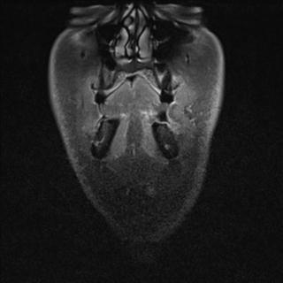 File:Base of tongue squamous cell carcinoma (Radiopaedia 31174-31884 E 20).jpg