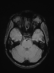 Basilar artery perforator aneurysm (Radiopaedia 82455-97733 Axial SWI 16).jpg