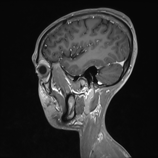File:Basilar artery perforator aneurysm (Radiopaedia 82455-97733 G 116).jpg