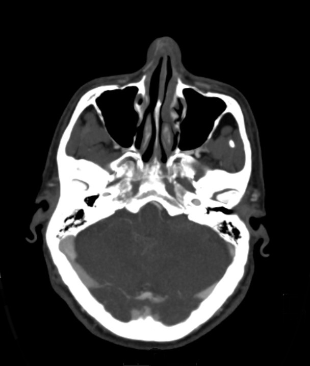 Basilar artery thrombosis and ascending transtentorial herniation (Radiopaedia 84759-100360 B 47).jpg