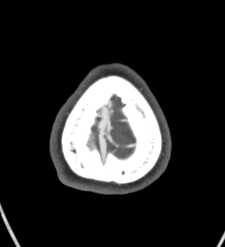 Basilar tip aneurysm with coiling (Radiopaedia 53912-60086 A 144).jpg