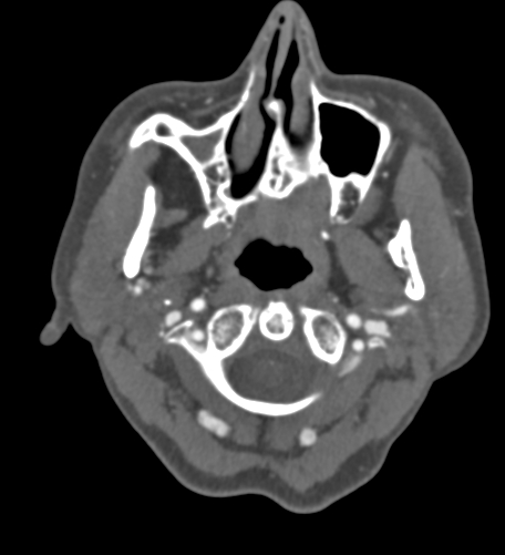 Basilar tip aneurysm with coiling (Radiopaedia 53912-60086 A 4).jpg