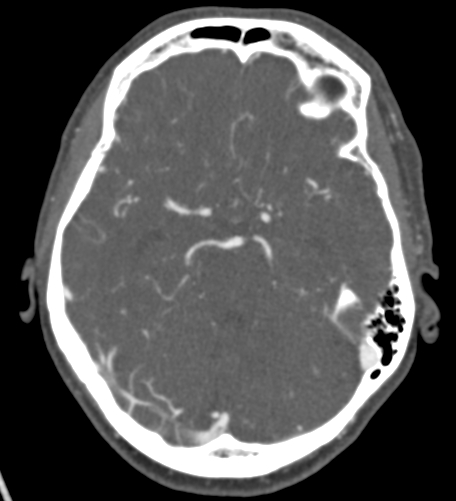 Basilar tip aneurysm with coiling (Radiopaedia 53912-60086 A 56).jpg