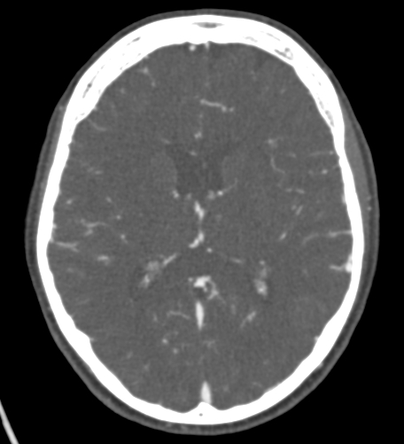 Basilar tip aneurysm with coiling (Radiopaedia 53912-60086 A 84).jpg