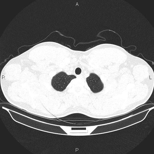 File:Beam hardening and ring artifacts (Radiopaedia 85323-100915 Axial lung window 10).jpg