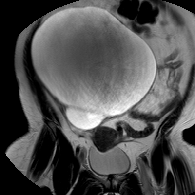 File:Benign seromucinous cystadenoma of the ovary (Radiopaedia 71065-81300 F 9).jpg