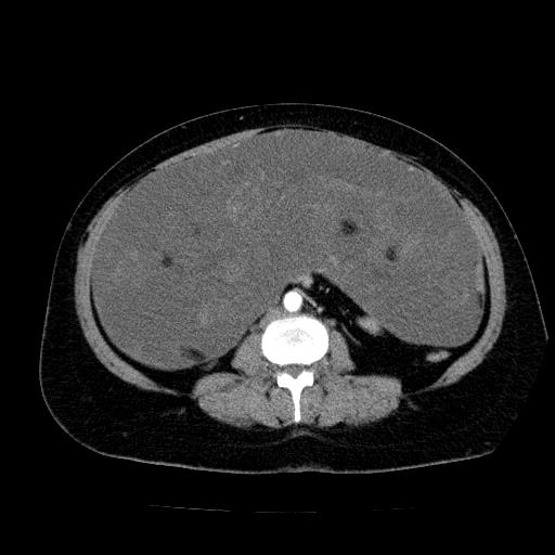 Benign spindle cell tumor - abdominopelvic (Radiopaedia 61300-69212 A 34).jpg