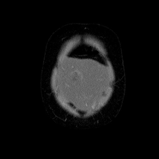 File:Benign spindle cell tumor - abdominopelvic (Radiopaedia 61300-69212 C 7).jpg