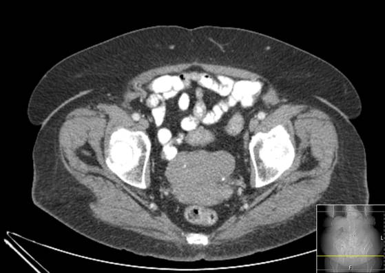 Bicameral celiacomesenteric aneurysm (Radiopaedia 55766-62327 A 64).jpg