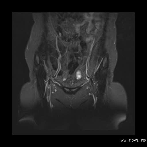 File:Bicornuate uterus- on MRI (Radiopaedia 49206-54297 Coronal STIR 2).jpg