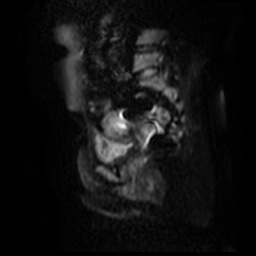 File:Bicornuate uterus (Radiopaedia 51676-57472 Sagittal DWI 12).jpg