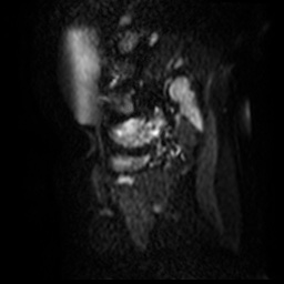File:Bicornuate uterus (Radiopaedia 51676-57472 Sagittal DWI 8).jpg